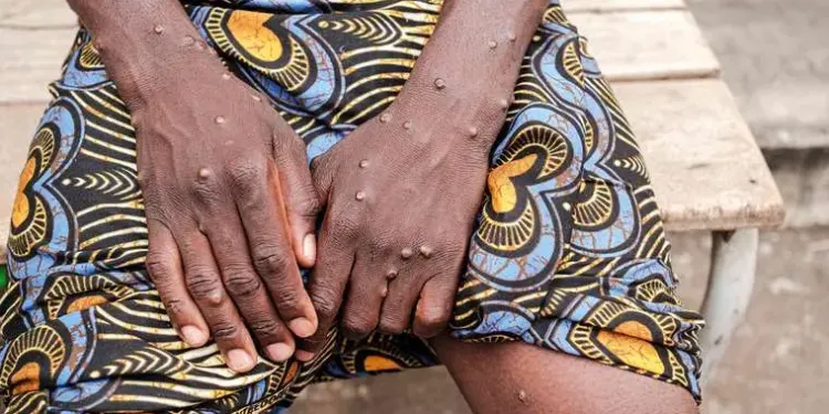 una paciente africana con mpox muestra sus